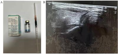 Preoperative application of carbon nanoparticles in transoral endoscopic thyroidectomy vestibular approach for papillary thyroid cancer